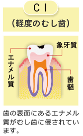 C1 軽度の虫歯