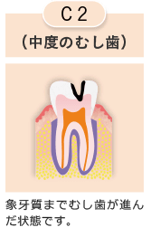 C2 中度の虫歯