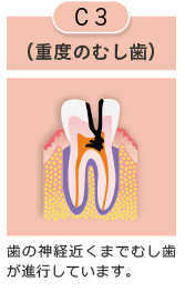 C3 重度の虫歯