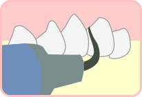 歯石の除去