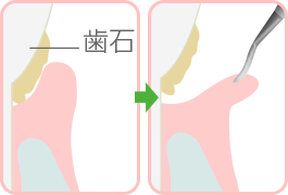 歯周ポケット掻爬術